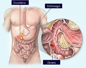 doencas estomacais 2