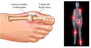 acido urico 2