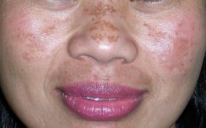 melasma 1