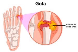 gota causas sintomas tratamento 2jpg